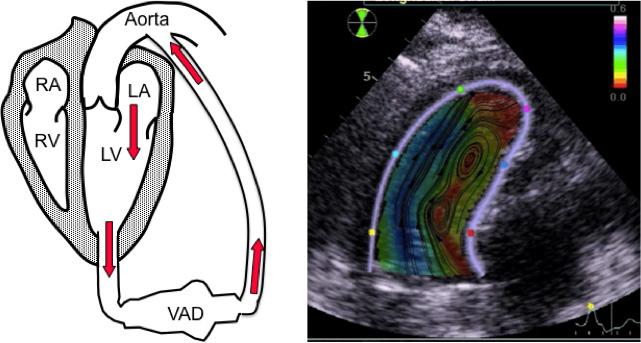 A diagram of a human heart cross section next to an x-ray of a human heart